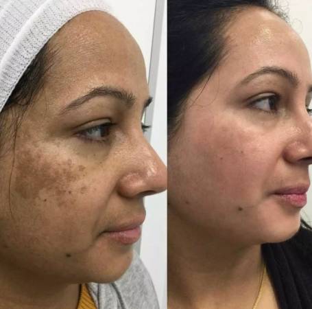Cosmelan® Depigmentation treatment result before after