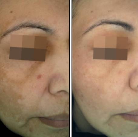 Cosmelan® Depigmentation treatment result before after