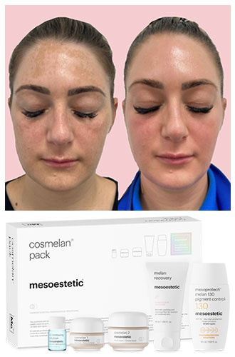 Cosmelan pack