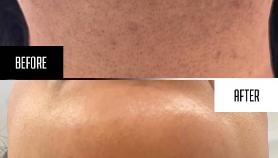 Before And After Face 3 Sessions thumbnail